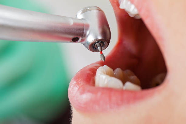 Best Emergency Tooth Extraction in Harriman, TN